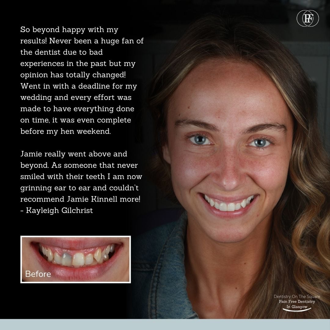 Kayleigh Gilchrist- Jamie Kinnell smile makeover (1)